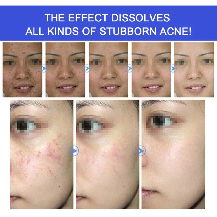 Description Picture 5 of itemNew Effective Acne Removal Cream Clears Blemish Pimple Remover Spot Safe Gentle Remove Acne Acne Cream For Clearing Severe Acne