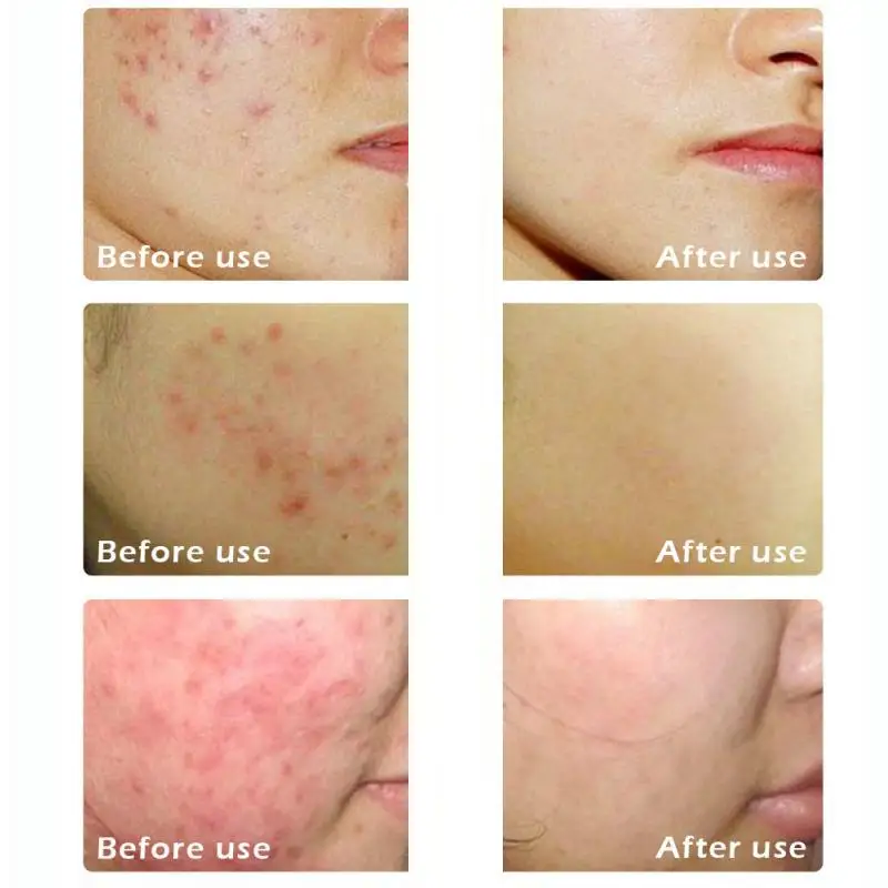 Description Picture 3 of itemAcne Treatment Cream Moisturizing Control Oil Shrinking Pores Remove Marks Pimple Removal Product