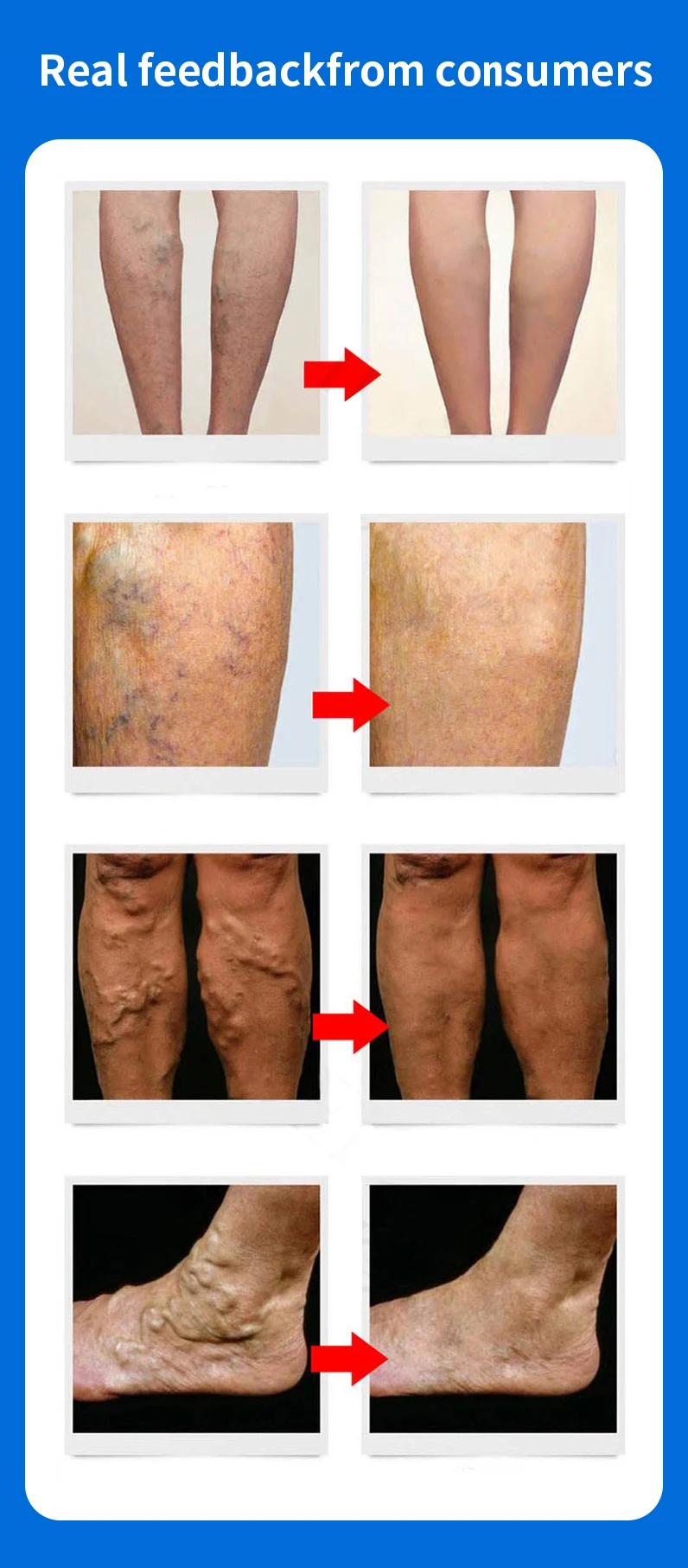 Description Picture 3 of itemVaricose Veins Treatment for legs, Cream for Circulation, Cooling Effect Diosmin and Horse Chestnut Cream for leg swelling relie