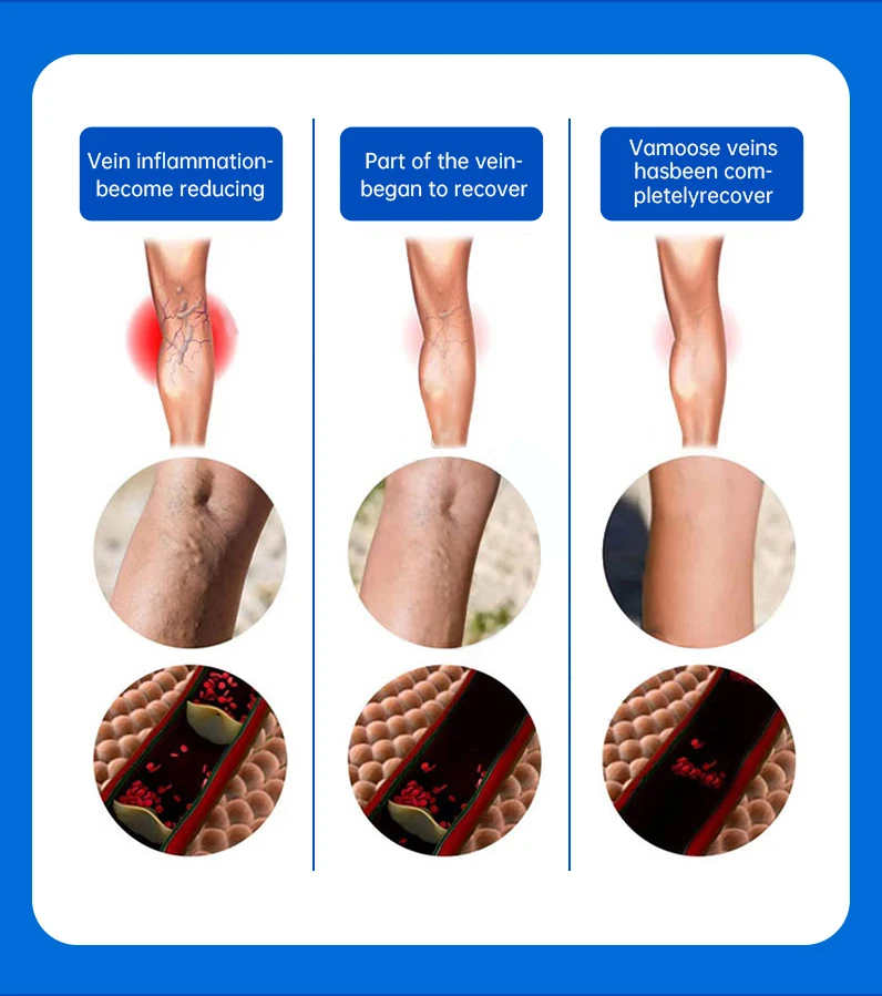 Description Picture 4 of itemVaricose Veins Treatment for legs, Cream for Circulation, Cooling Effect Diosmin and Horse Chestnut Cream for leg swelling relie