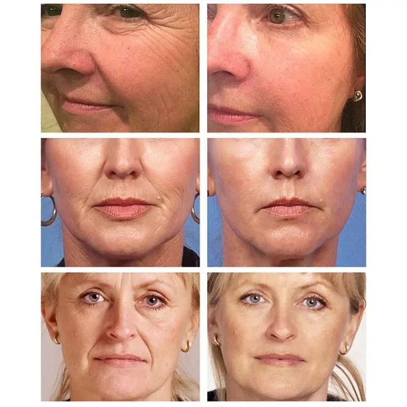 Description Picture 4 of item5 Seconds Retinol Wrinkle Remover Face Cream Anti-Aging Firm Lifting Fade Fine Line Improve Puffiness Whiten Women Men Skin Care