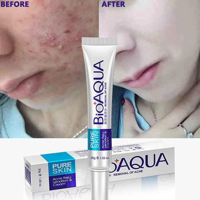 Description Picture 2 of itemBIOAQUA Effective Acne Removal Cream Herbal Acne Spots Oil Control Acne Cream Skin Care Whitening Moisturizing Face Gel  20g