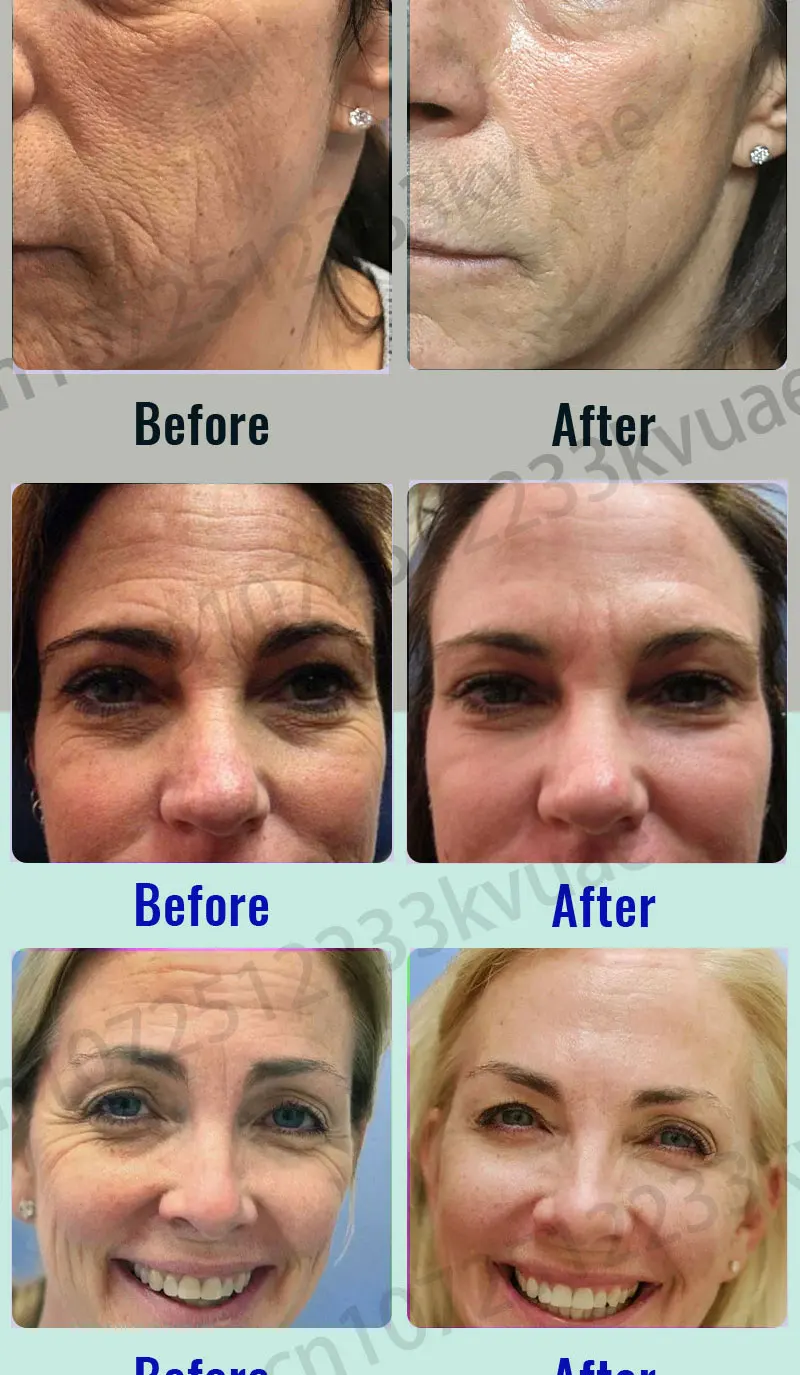 Description Picture 3 of itemEffective Anti-Ageing And Anti-Wrinkle Facial Serum To Remove Facial Wrinkles Fine Lines Around The Eyes Crow's Feet Neck Wrinkl