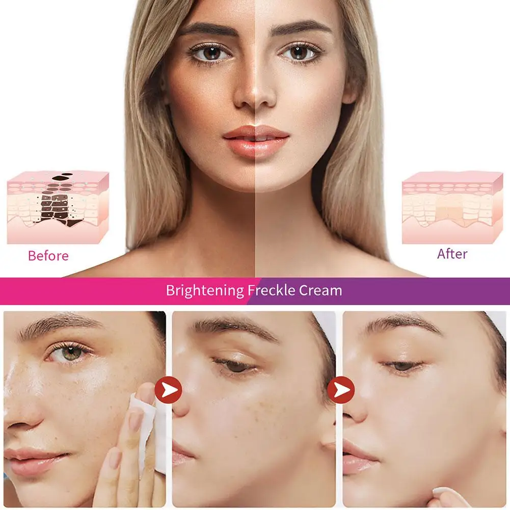 Description Picture 5 of itemWhitening Freckles Cream Remove Melasma Dark Spot Lightening Removal Melasma Remover Moisturize Brighten Face Skin Care