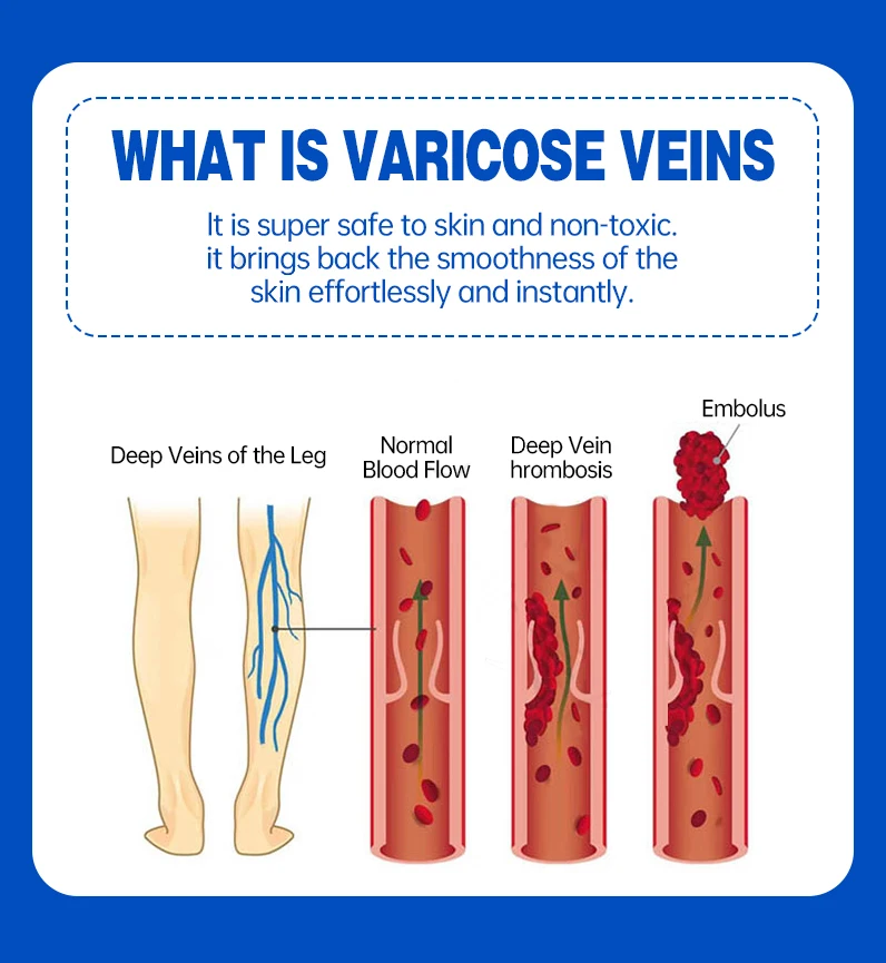 Description Picture 5 of itemVaricose Veins Treatment for legs, Cream for Circulation, Cooling Effect Diosmin and Horse Chestnut Cream for leg swelling relie