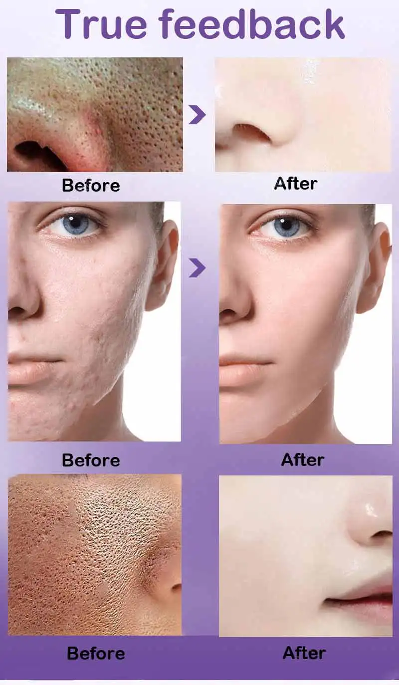 Description Picture 4 of itemPore Skin Care Serum Facial Essence for Shrinking Pores Relieving Dryness Moisturizing Oil Control Firming