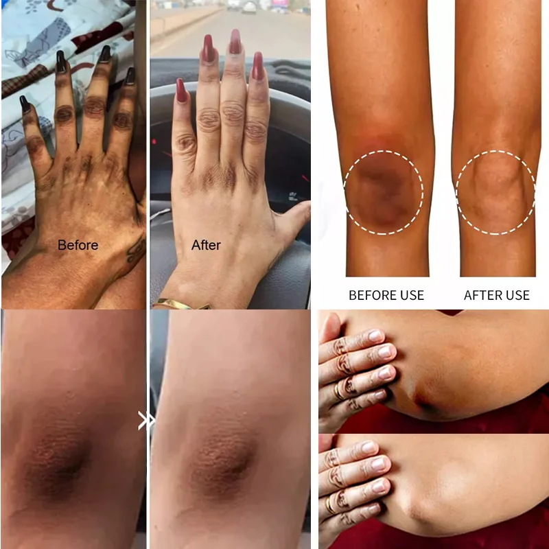 Description Picture 3 of itemFast Whitening Dark Knuckles Cream Pigmentation Correctors For Black Skin Hand Knuckle Elbows Knee Intense Stains Remover Cream