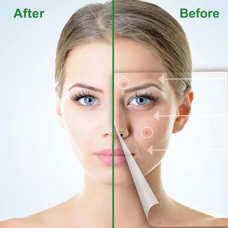 Description Picture 5 of itemAcne Pimple Patch Sticker Acne Treatment Pimple Remover Tool Blemish Spot Facial Mask Skin Care маска для лица