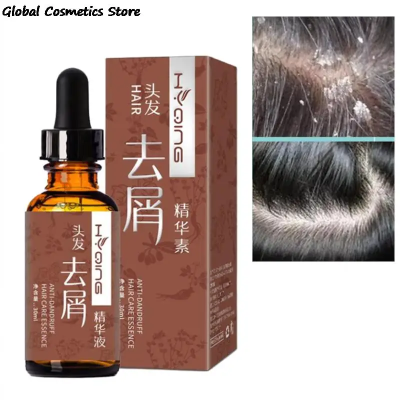 30ml Organic Anti-Dandruff and Exfoliating Scalp Treatment Serum Anti-Itch Smoothing Anti-Loss Hair Scalp Repair Serum