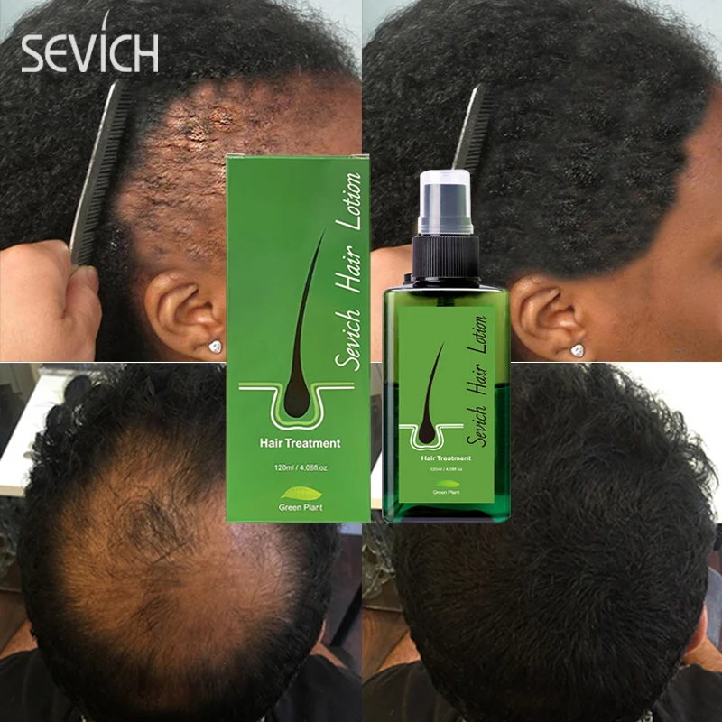 Sevich Rapid Hair Growth Spray 120ml Anti Hair Loss Treatment Essence For Men Women Fast Regrowth Oil Scalp Care Product