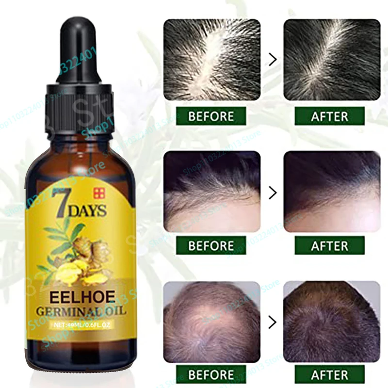 Ginger Hair Growth Product Anti-loss Hair Regrowth Serum Oil Fast Grow Prevent Baldness Treatment Alopecia Men Women Hair Care
