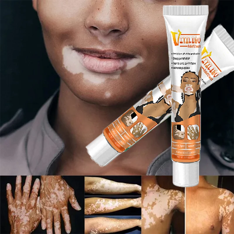 Effectively Remove Vitiligo Ointment Remove Ringworm White Spot Removal Skin Vitiligo Eliminate Vitiligo Skin Care